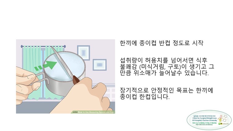 고도비만수술의 대세 위소매절제술 후 일반식하기